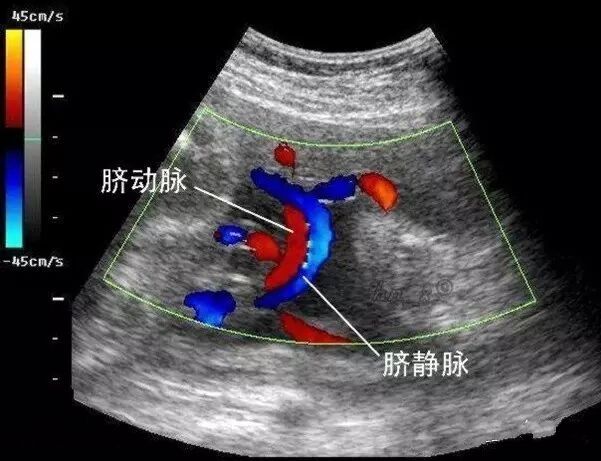 而胎儿如果只有1条脐动脉,1条静脉叫做单脐动脉.